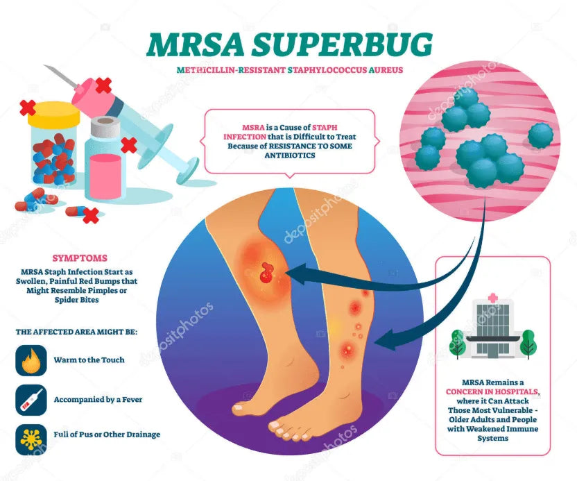 In-Depth Guide to Staphylococcus aureus (MRSA): Causes, Prevention & Treatment