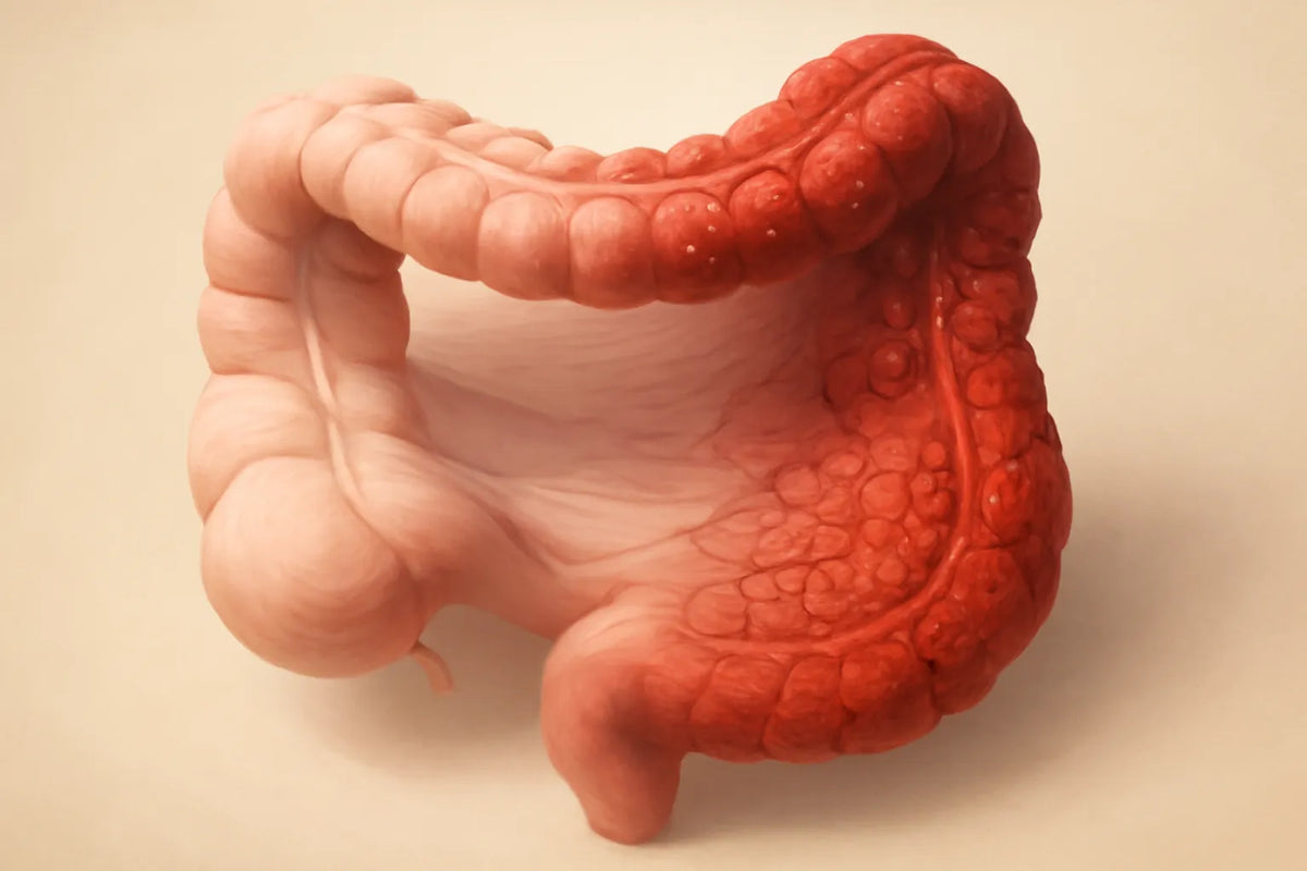 ulcerative colitis
